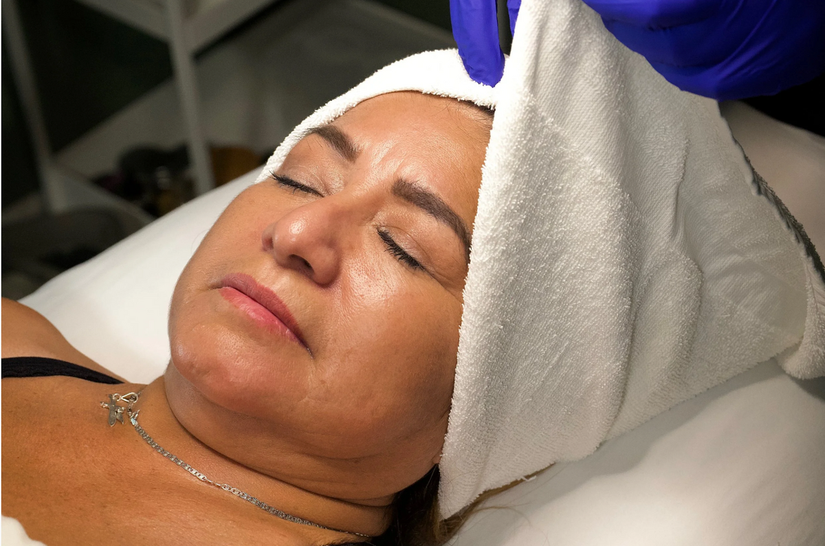 RF microneedling treatment at Olivia's Heritage med spa in Watsonville