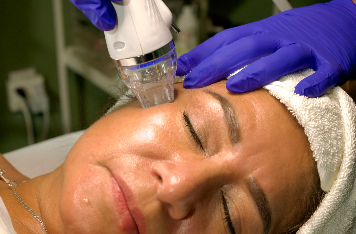 Microneedling treatment at Olivia's Heritage med spa in Watsonville